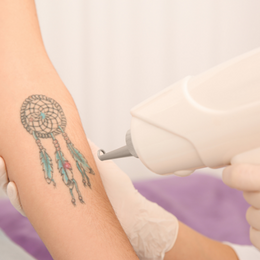 Tattookleuren verwijderen met laser