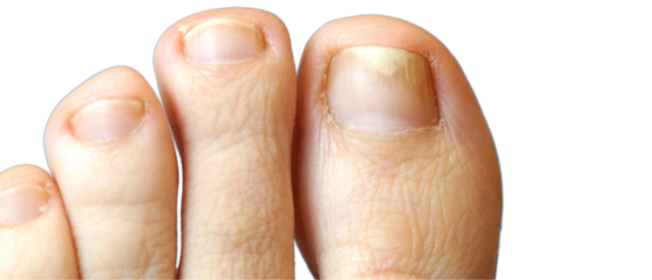 Psoriasis nagels