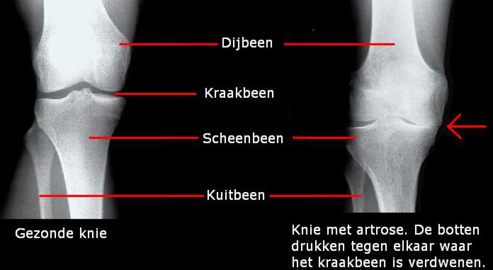 Met de Versla Artrose Methode pak jij knie artrose effectief aan