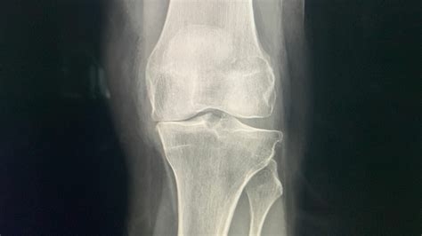 Met de Versla Artrose Methode pak jij knie artrose effectief aan