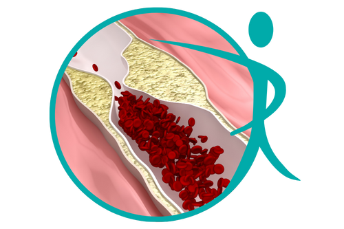 claudicatio intermittens