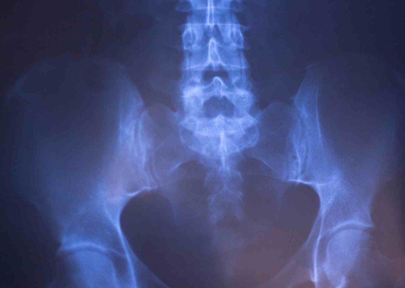 Rontgenfoto Lage Rug? Wanneer WEL/NIET? Door de Lage Rugpijn Fysio Rontgenfoto Lage Rug? Wanneer WEL/NIET? Door de Lage Rugpijn Fysio