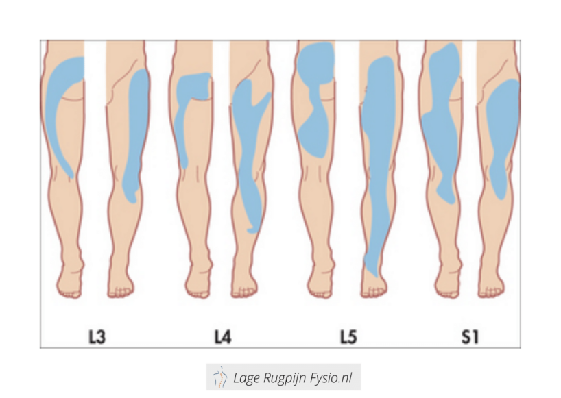 Lage Rugpijn Uitstraling Been?! Wat Heb Ik?