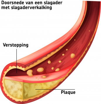 doorsnede-bloedvat - LEV&Healthy