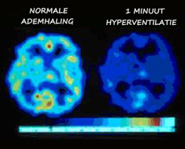 De opname van zuurstof door de hersenen bij hyperventilatie