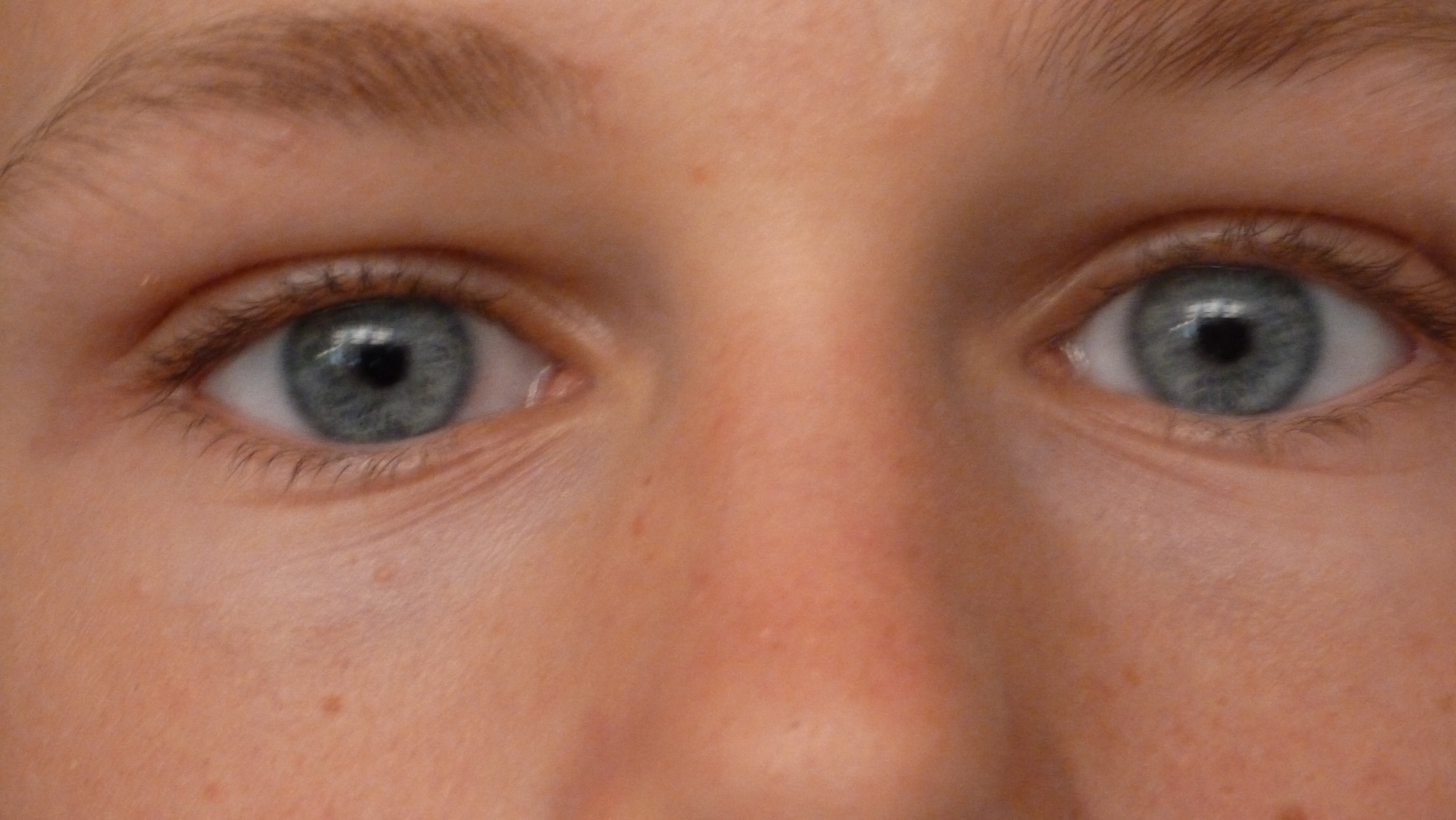 Wat als je door eczeem op je ogen letterlijk en figuurlijk niet voldoende zicht hebt?