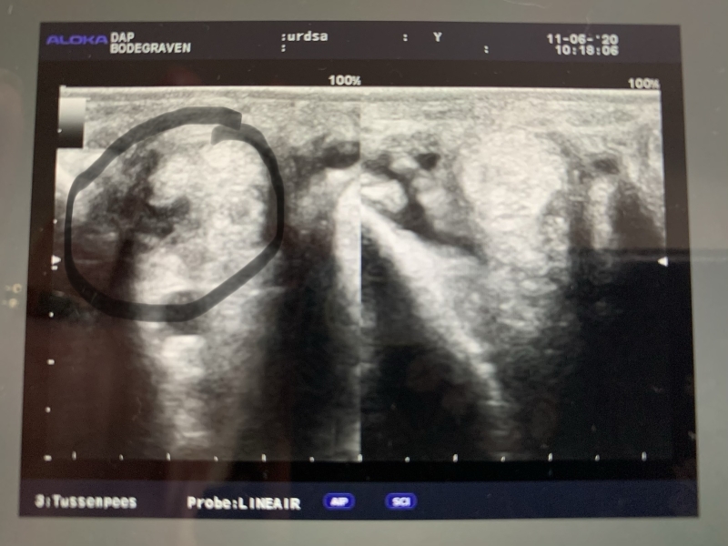 interosseus damage before laser therapy