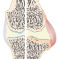 osteo arthrosis