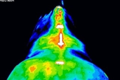 thermal image kissing spine after pemf treatment