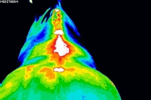 thermal image kissing spine before pemf