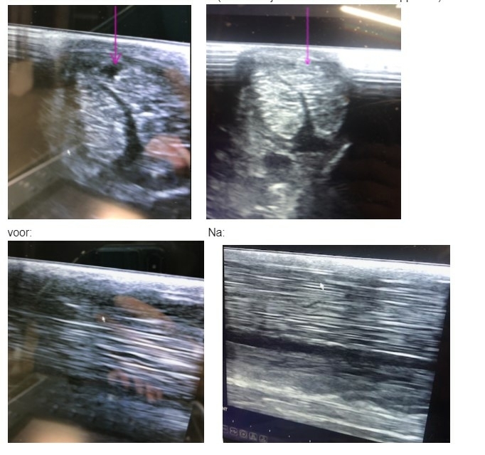gaatje oppervalkkige buiger herstelt met magneetveldtherapie gaatje oppervalkkige buiger herstelt met magneetveldtherapie