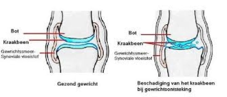 Artrose en hoe magneetveldtherapie daarbij kan ondersteunen