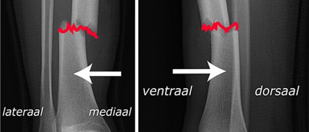 Botbreuken en Pulserend Magneetveld Therapie