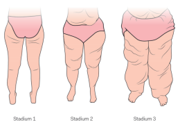 Abnormale vetverdeling op de benen