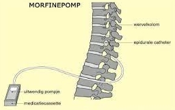 morfinepomp-in-lichaam bij het ruggengraat