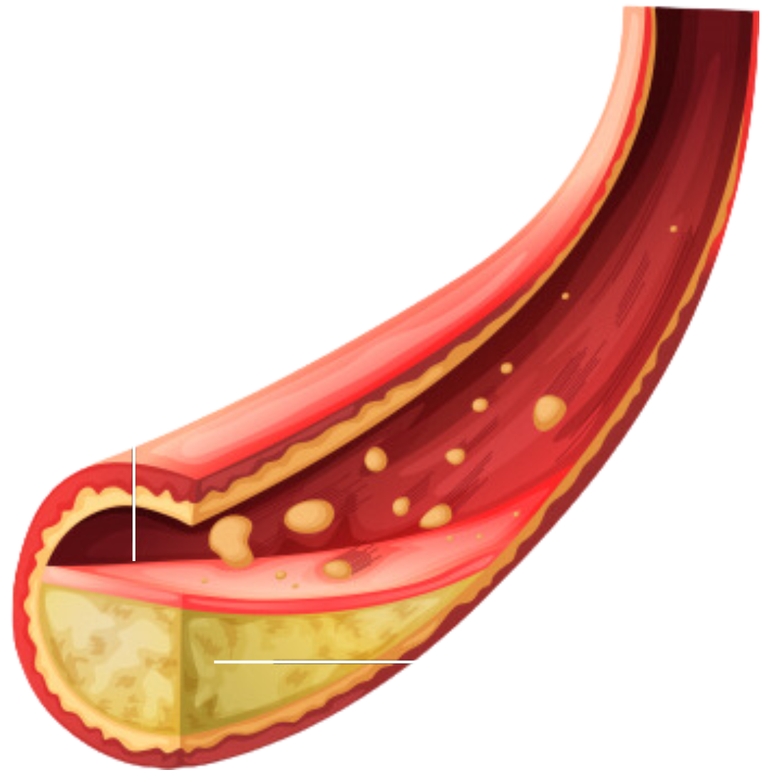 dichtgeslibde-verklakte-bloedvaten-melaniekiers-nl