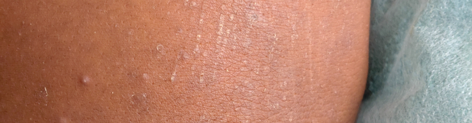 Een droge huid in een gekleurde huid