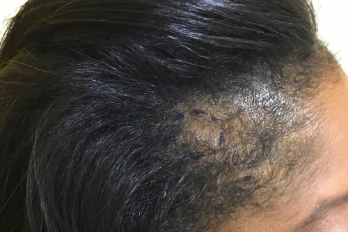 alopecia haarverlies hoofdhuid gekleurde vrouw JDD mellacare