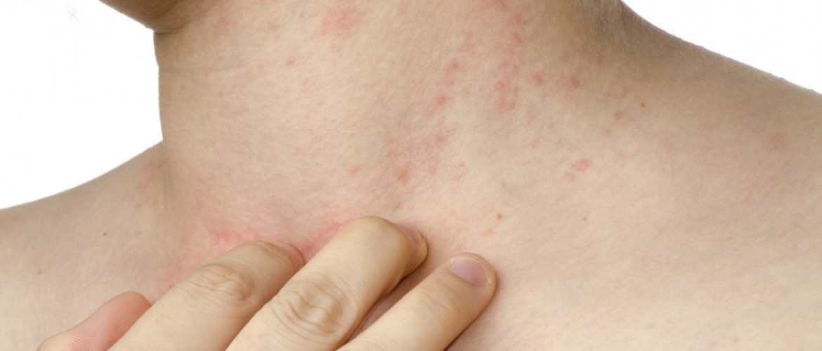 red-spots-on-skin-due-to-stress-milltain