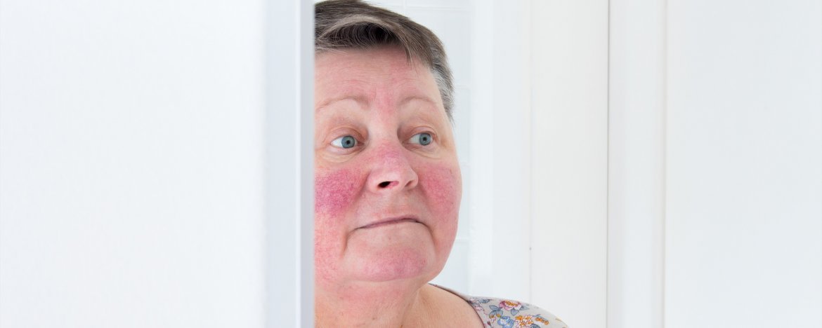 Rosacea Symptomen En Behandelingen
