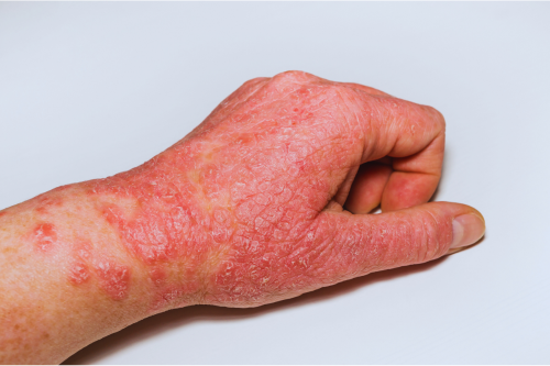 kennisbank atopisch eczeem