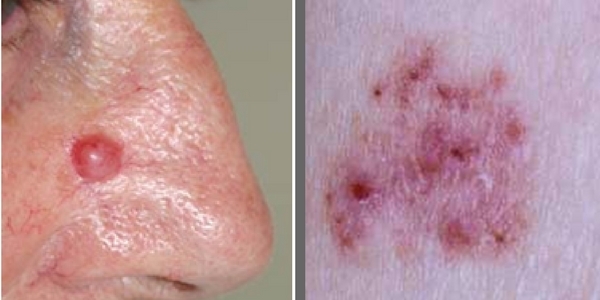 Het basaalcelcarcinoom