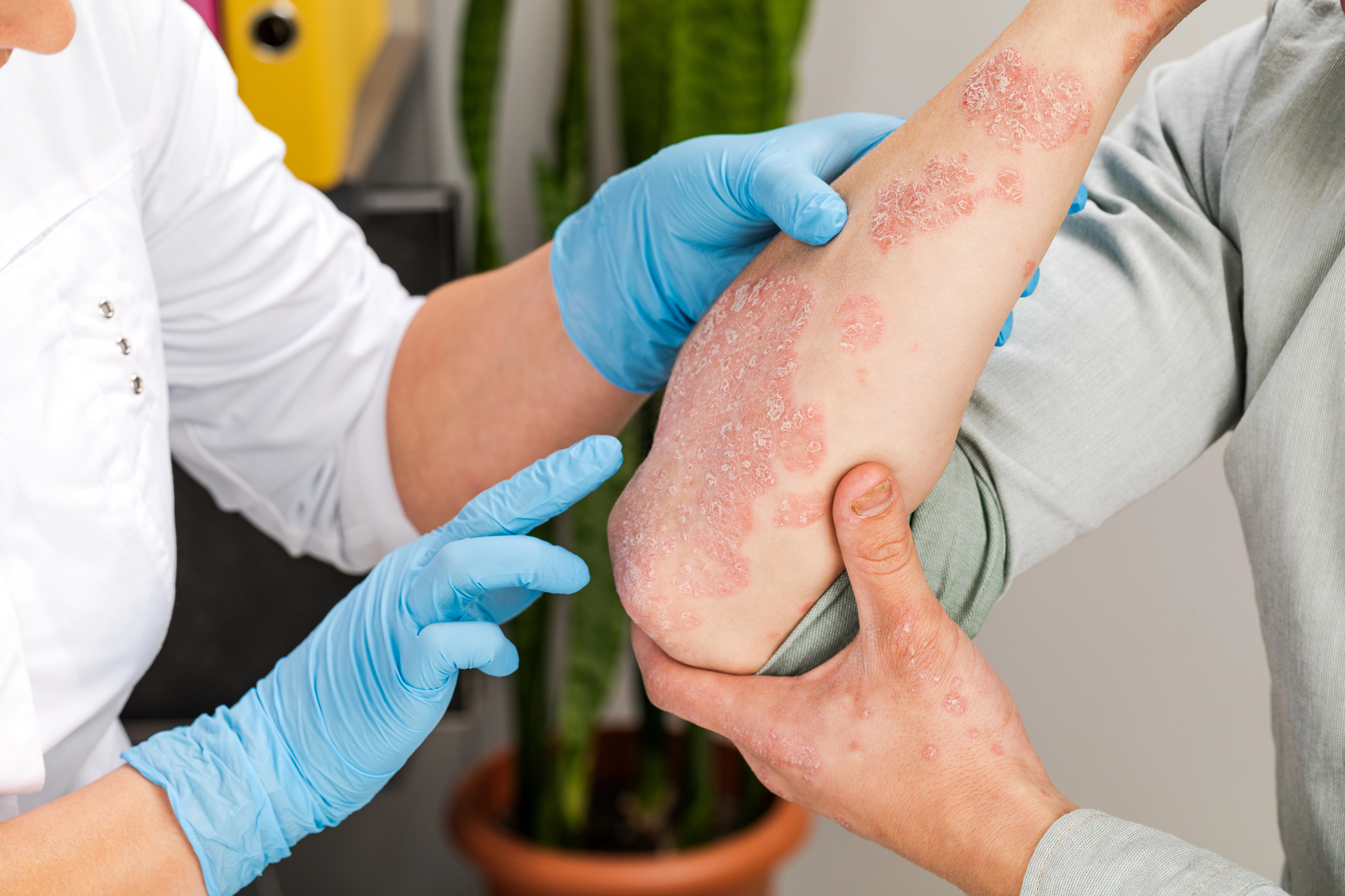 Psoriasis – Oorzaken, beloop en symptomen uitgelegd