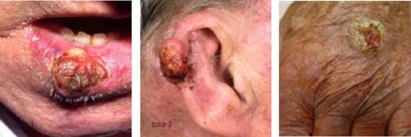 Het plaveiselcelcarcinoom