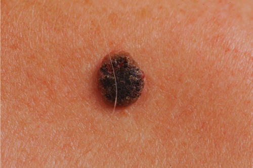 kennisbank huidkanker