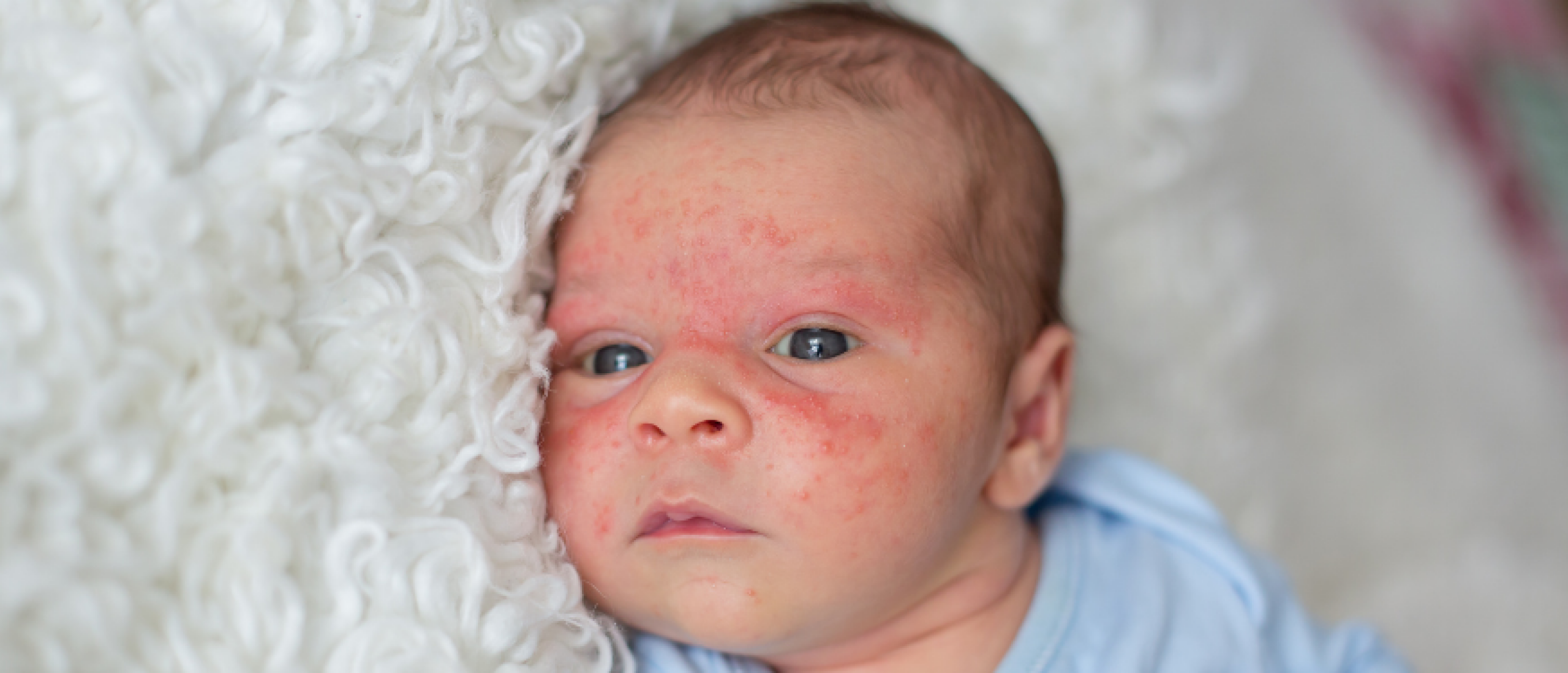 Kinderboeken over eczeem