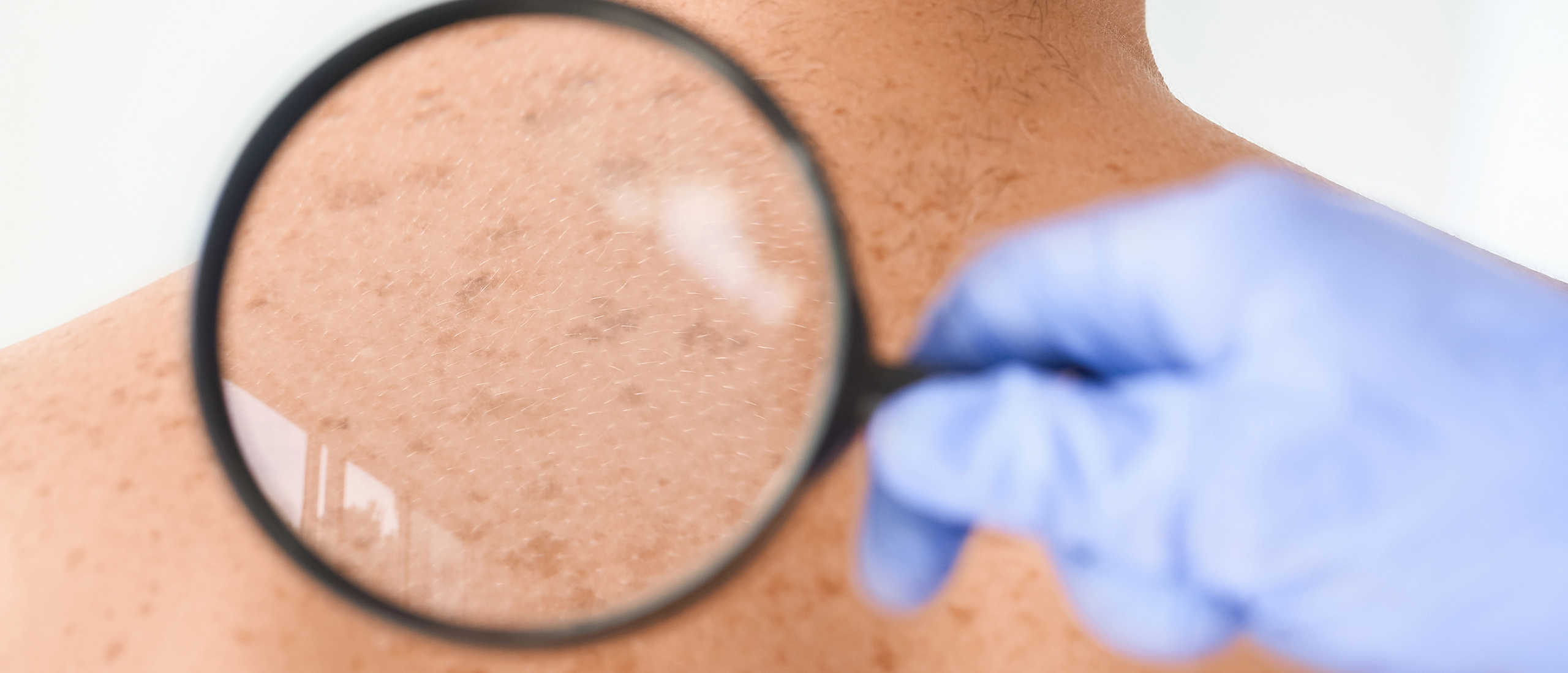 Lentigo Maligna Lentigo Maligna