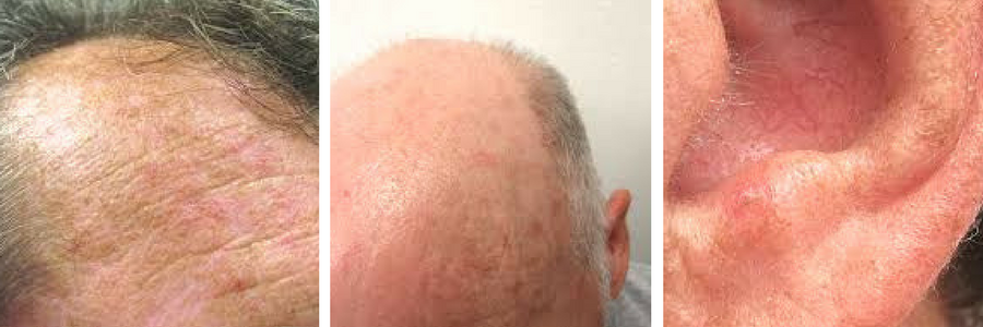 Actinische keratosen Actinische keratosen