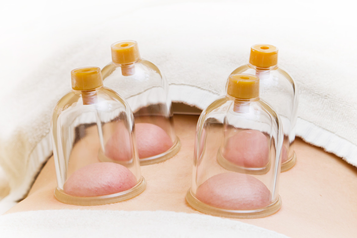 cupping massage is a holistic therapy
