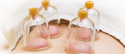 What is Cupping Therapy