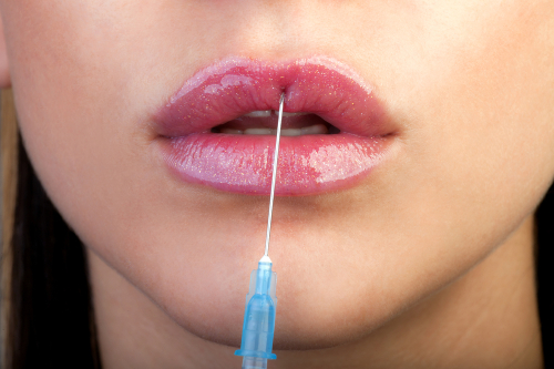 Lipfiller feit en fabel Lipfiller feit en fabel