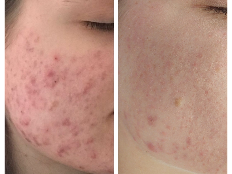voor en na acne behandeling arnhem