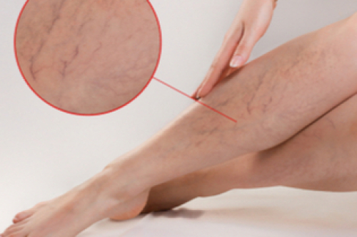 Spataderen verwijderen Spataderen verwijderen