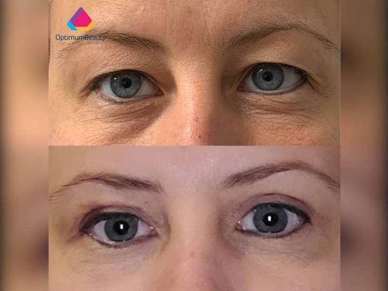 resultaat ooglidcorrectie