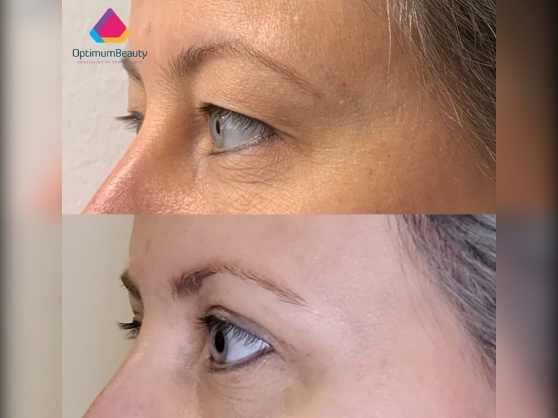 resultaat ooglidcorrectie