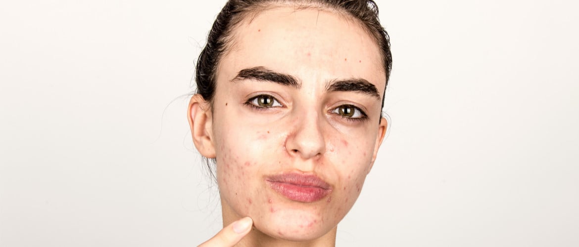 5 dingen die je beter niet kunt doen wanneer je last hebt van acne