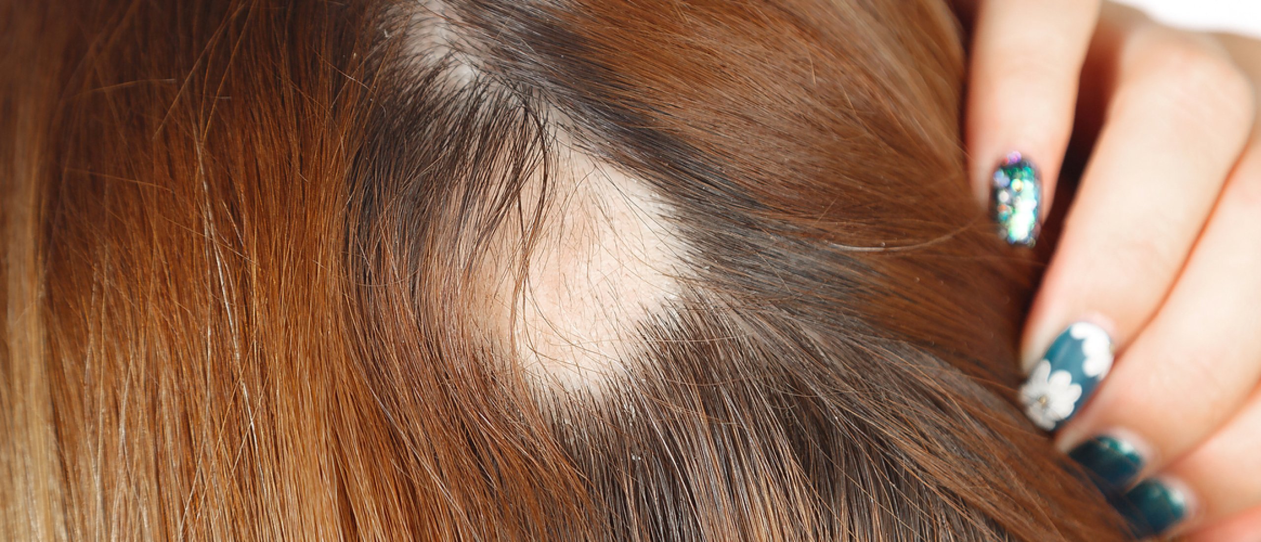 Alopecia. Oorzaak en behandeling