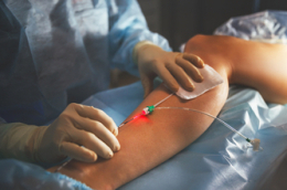 Endoveneuze laser