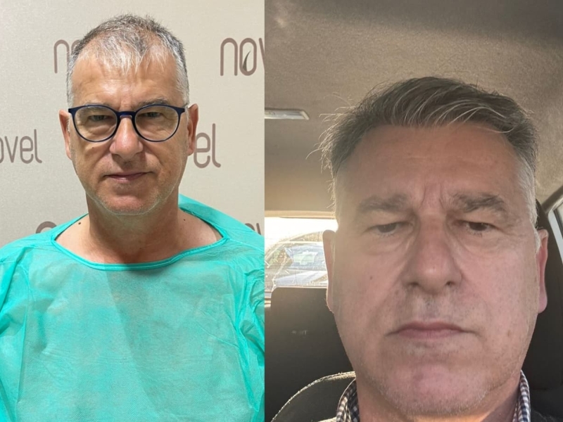 This is the result of our DHI Hair Transplantation in Albania. The patient came from UK and booked the treatment in our Hair Transplant Clinic