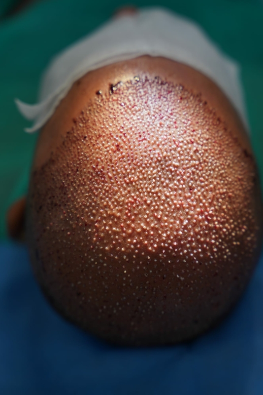Uitleg van het haartransplantatieproces waarbij grafts worden verplaatst van het donorgebied naar zones met haarverlies. Een veelgekozen behandeling binnen het internationale medisch toerisme in landen zoals Albanië en Turkije.