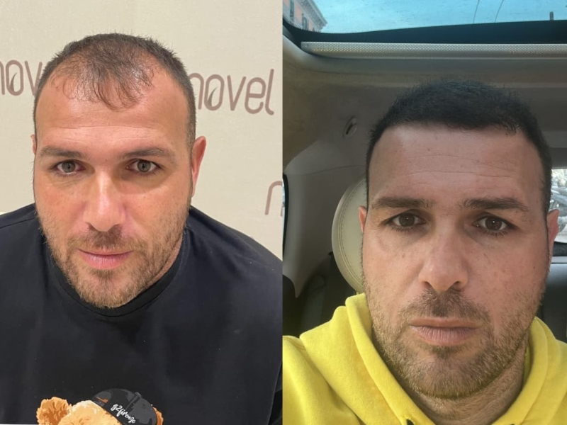 This is the result of our FUE Hair Transplantation in Albania. The patient came from UK and booked the treatment in our Hair Transplant Clinic