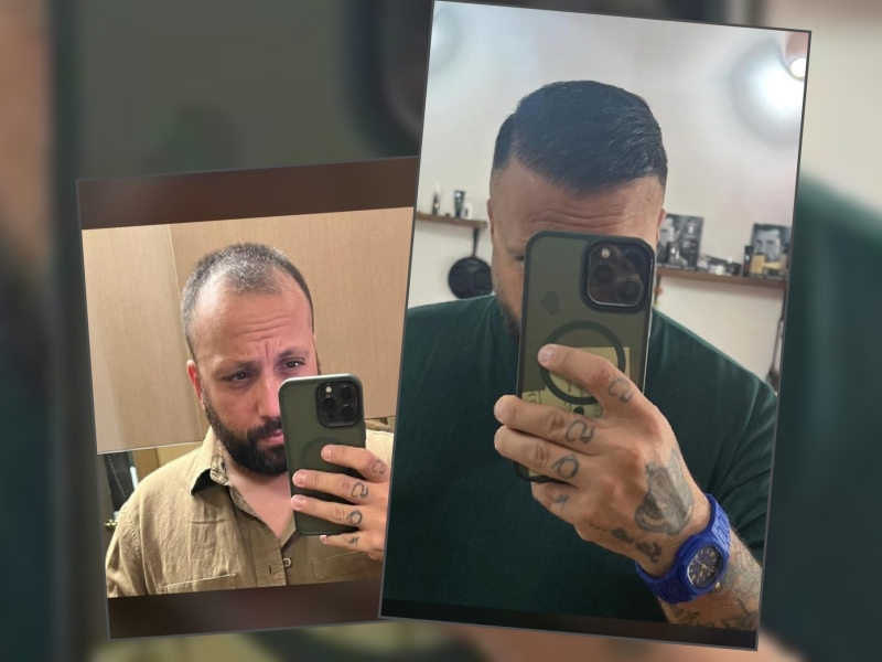 Hair Transplant Packages in Albania are affordable and high quality. For UK Clients it's a great deal to travel and change their hair loss!