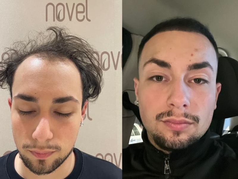 You want to do your Hair Transplant in Turkey or Albania? There's benefits in a less commercialized market as Albania - because quality tends to be a bit higher.