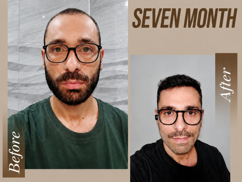 Free Hair Transplant Assessment Online Video consultation for hair transplant treatment in Albania with Prime Hairlines