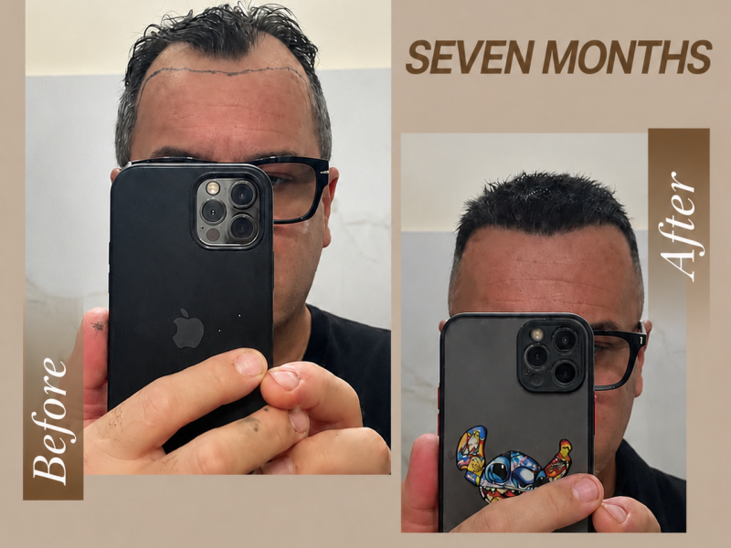 Online Consultation Online hair transplant consultation with Prime Hairlines in Durrës, Albania