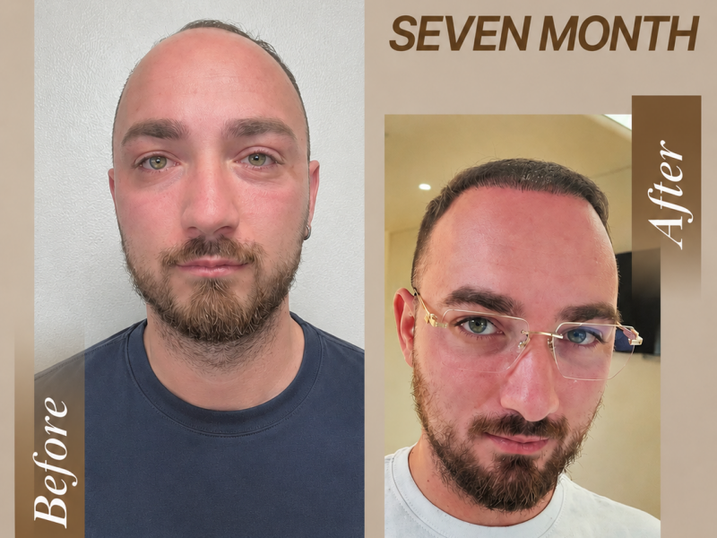 DHI Hair Transplant Consultation Albania Online consultation for DHI hair transplant in Albania